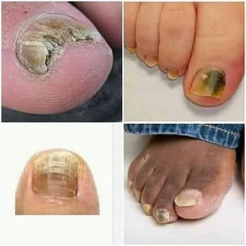 Fabriquez une pâte avec du bicarbonate et de l’eau, puis appliquez sur l’ongle