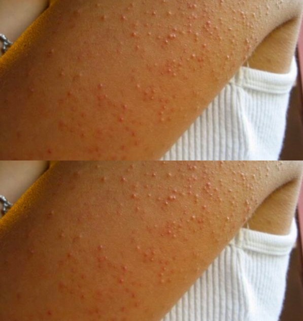 Intolérance au gluten : les symptômes qu’il ne faut pas négliger