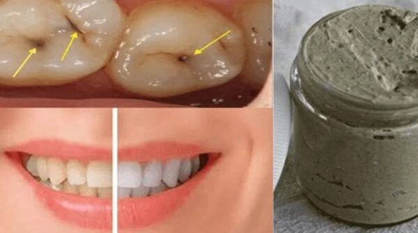 Le dentifrice fait maison qui blanchit les dents, soigne les caries et les maladies des gencives