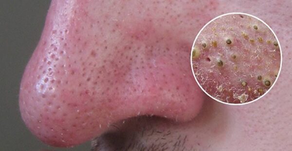 Les 5 remèdes les plus efficaces pour éliminer les points noirs en un rien de temps