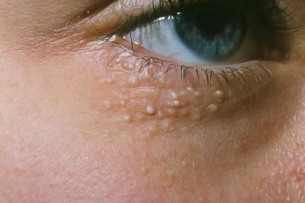Milium Autour Des Yeux : 5 Solutions Naturelles Pour Les Éliminer