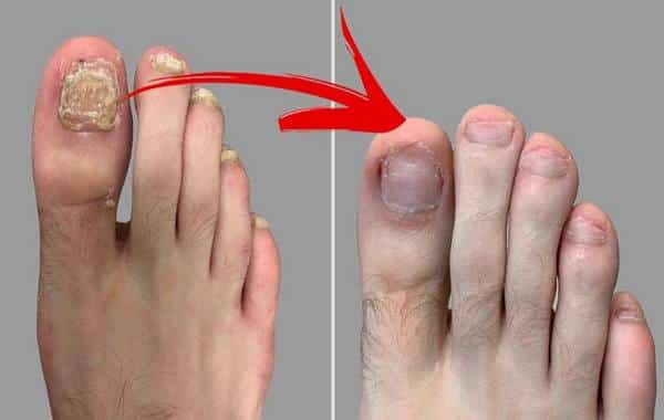 Mycose des Ongles : 5 Remèdes Naturels pour la Soigner