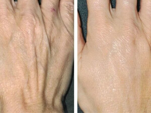 RAJEUNISSEZ VOS MAINS DE 10 ANS AVEC CE MASQUE AUX INGRÉDIENTS NATURELS