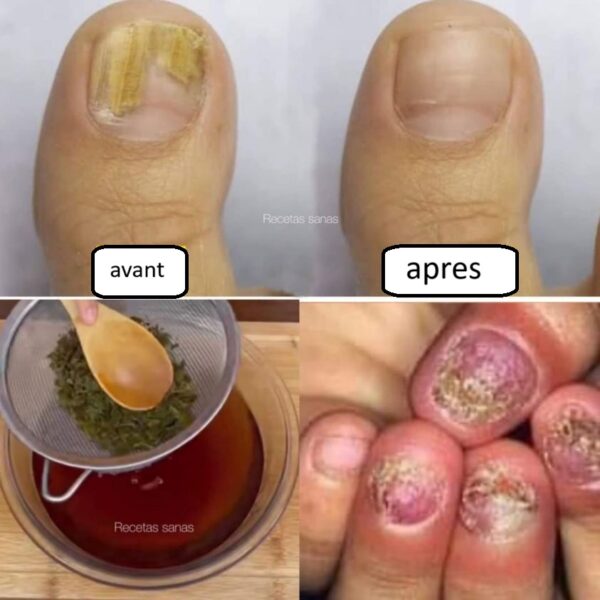 Remède naturel pour aider à éliminer la mycose des ongles
