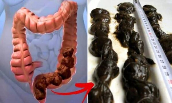 Remèdes naturels pour nettoyer et désintoxiquer le côlon