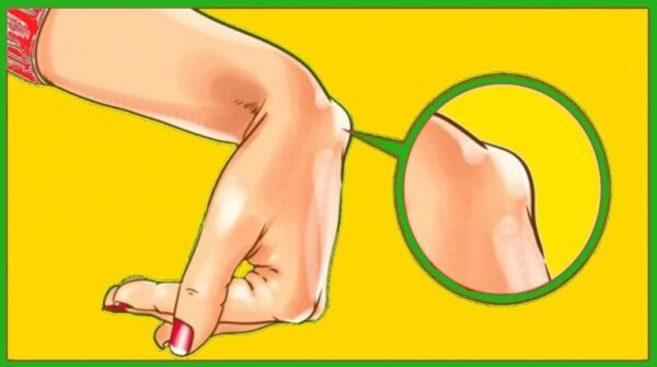 Si vous avez cette bosse au poignet, vous devez peut-être vous inquiéter