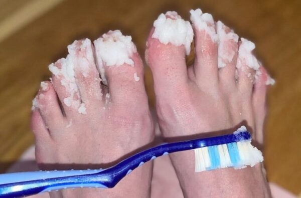 Si vous avez une mycose des ongles essayez ce remède naturel : elle disparaît rapidement