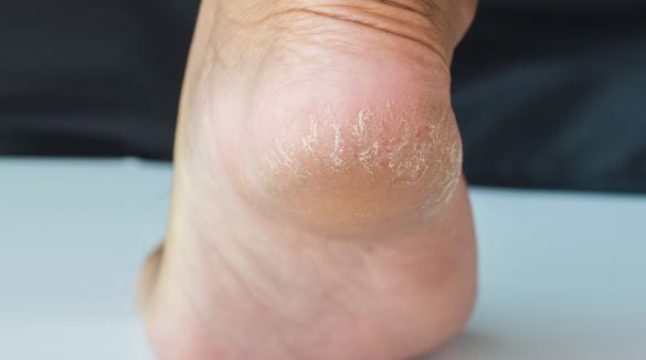 Un Remède efficace pour lutter contre les Pieds Secs !