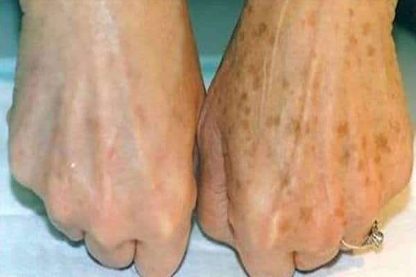 Voici Comment Utiliser Cette Recette Pour Éliminer Les Taches Brunes Sur Les Mains