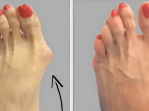 Voici Comment se Débarrasser des Oignons de Pieds