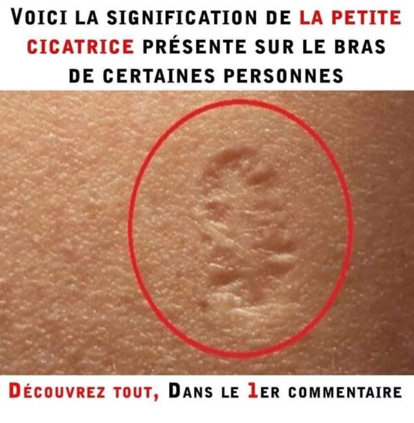 Voici la signification de la petite cicatrice présente sur le bras de certaines personnes !
