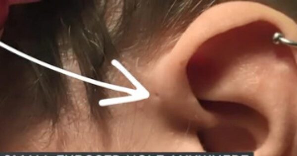 Voici pourquoi certaines personnes naissent avec ce petit trou juste au-dessus de l’oreille