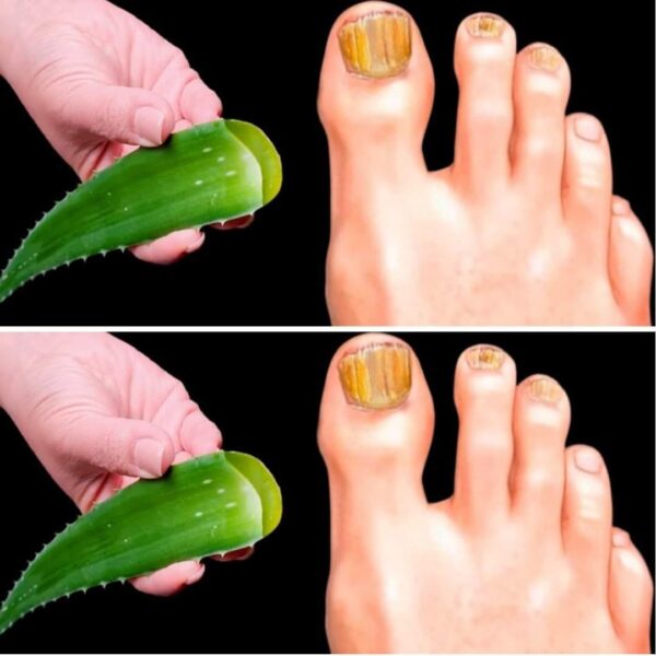 Élimine immédiatement la mycose des ongles ! Le meilleur remède !