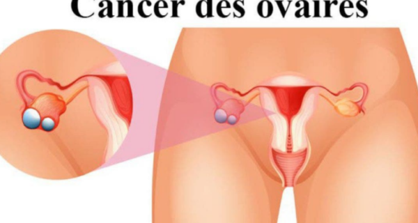 ovaires est un tueur silencieux, voici 8 signes à détecter
