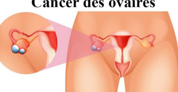 ovaires est un tueur silencieux, voici 8 signes à détecter
