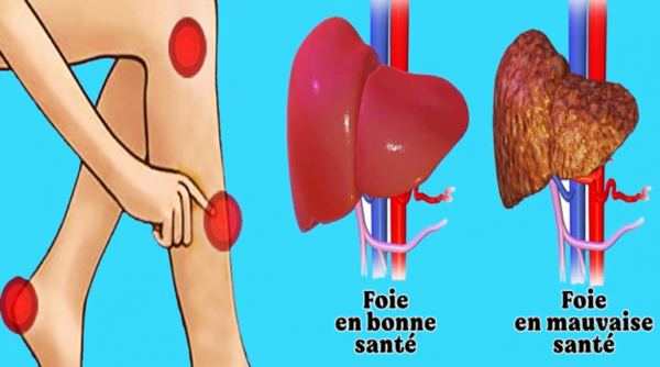 5 symptômes qui montrent que votre foie est en mauvaise santé