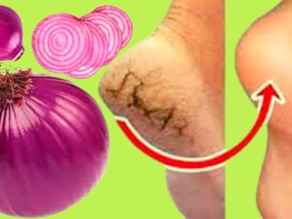 J’ai tout essayé, mais il s’avère que ma mère connaît le meilleur ASTUCE pour les talons craquelés : il faut un oignon ordinaire !