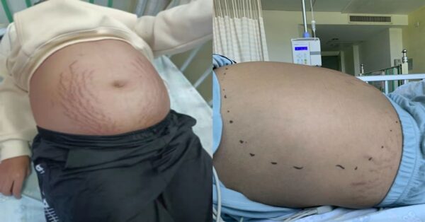 13-YO girl’s belly “covered with stretch marks”, what doctors takes from her belly makes her parents regret