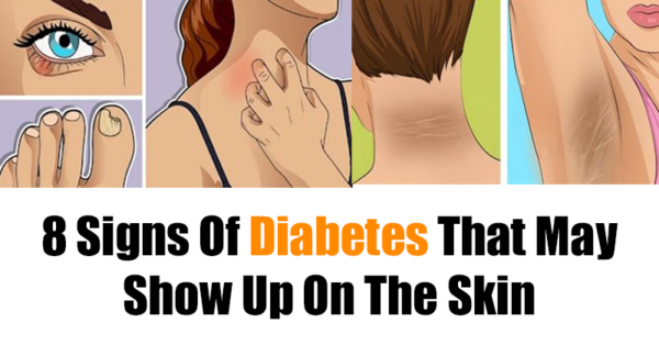 8 Signs Of Diabetes That May Show Up On Your Skin