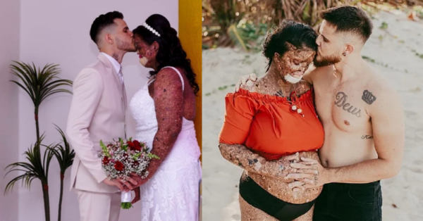 Conquering all negativity, the woman with a rare skin disease finds true love