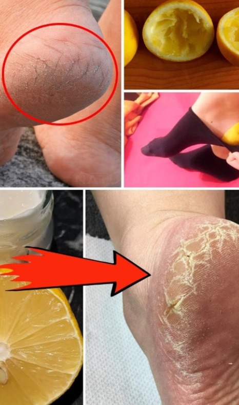 Cracked Heels: Unstoppable Grandma’s Cure