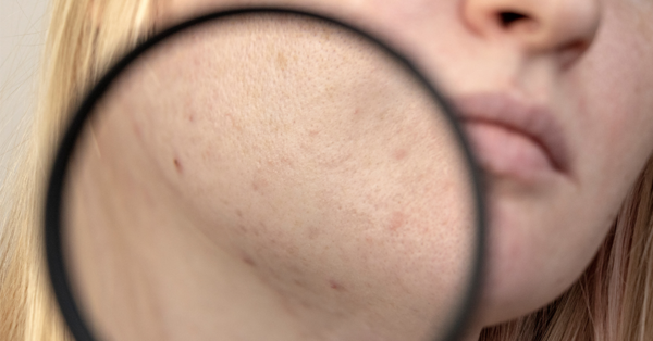 Every time you have dark spots or black spots on your face, take a lemon and do these things to get rid of them