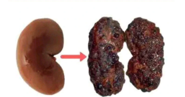 Everyone Should Avoid Kidney Problem By Staying Away From These 10 Habits