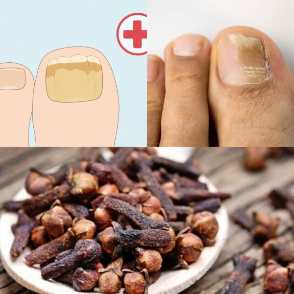 Harnessing the Power of Cloves: A Natural Remedy for Nail Fungus