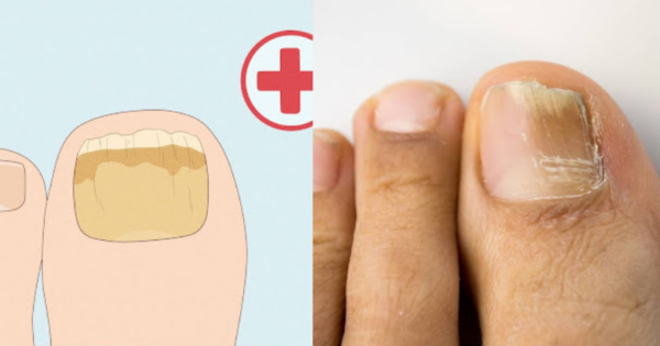 Harnessing the Power of Cloves: A Natural Remedy for Nail Fungus