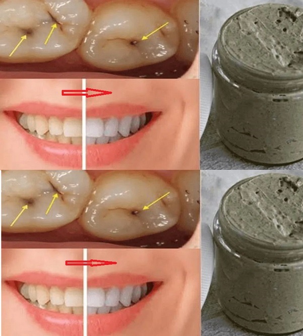 Homemade toothpaste that whitens teeth, treats cavities and gum disease