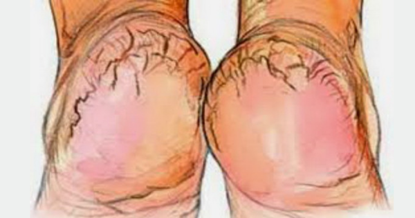 If You Have Cracked Heels This is a 100% Efficient and Inexpensive Solution (Recipe)