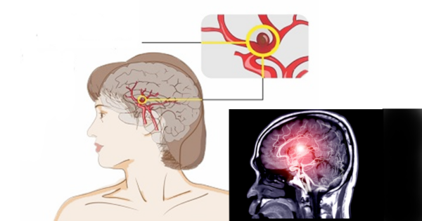 If you’re feeling chest pain along with heavy breathing, get your brain checked to see if you have this lífє-thrєαtєníng dísєαsє