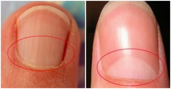 Immediately Visit A DOCTOR If You’re Experiencing Any Of The Following Symptoms Along With An Absence Of Lunula