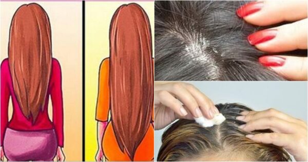 Just Apply This On Your Hair, And They Will Grow Nonstop and Resolve Dandruff Problem Too.