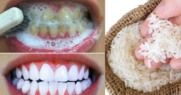 RAPID TEETH WHITENING to achieve a pearly white smile