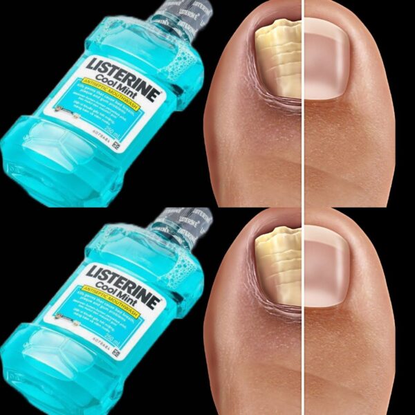 Say Goodbye to Nail Fungus with This Simple Home Remedy