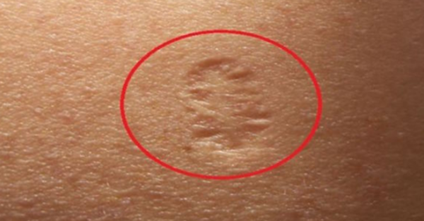 The Truth Behind The Small Scar On Upper Left Arm. Here’s What It Really Means