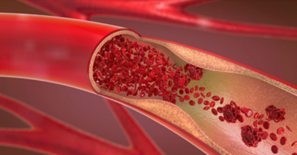 The recipe to lower your blood pressure numbers in 3 minutes. Everyone can make this at home