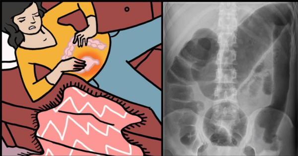 Toxic megacolon: 6 alarming signs and symptoms of this life-th.r.e.a.t.e.n.i.n.g condition