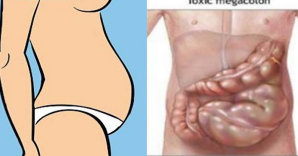 Your Big Tummy Isn’t Fat.  Your Stomach Gets Bloated, This Is How To Get Rid Of It