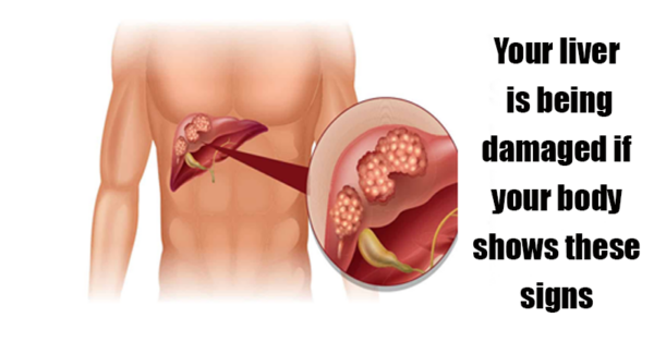 Your liver is being damaged if your body shows these signs